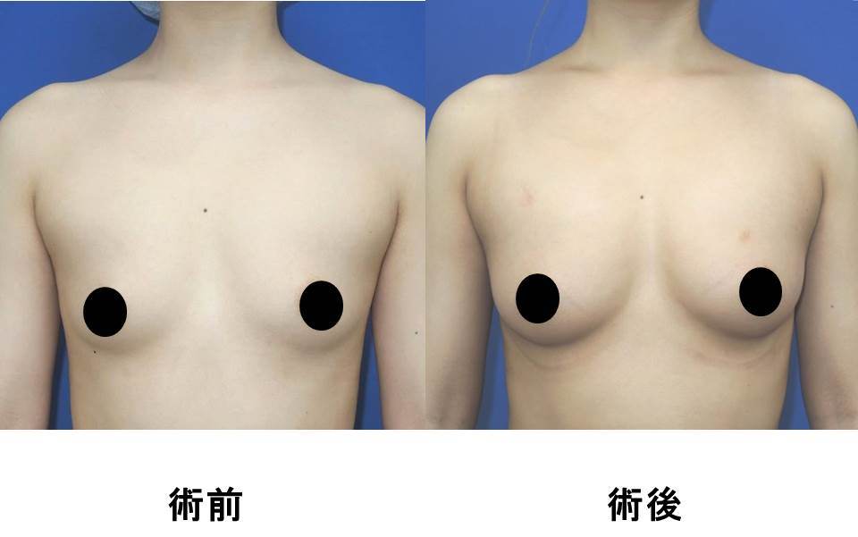 豊胸　術前 