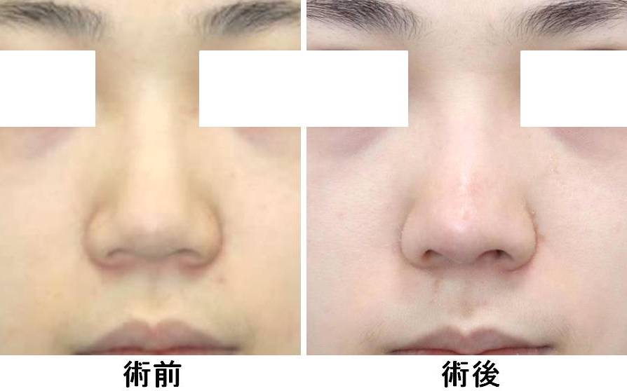 鼻形成 銀座s美容 形成外科クリニック