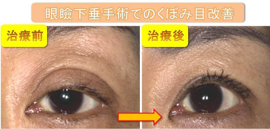 まぶたのくぼみ治療 銀座s美容 形成外科クリニック