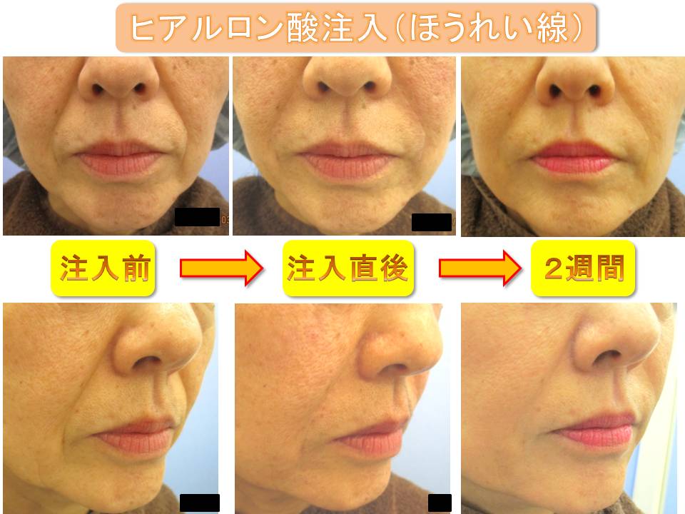 ヒアルロン酸注射糸リフト 銀座s美容 形成外科クリニック ヒアルロン酸注射糸リフト 銀座s美容 形成外科クリニック