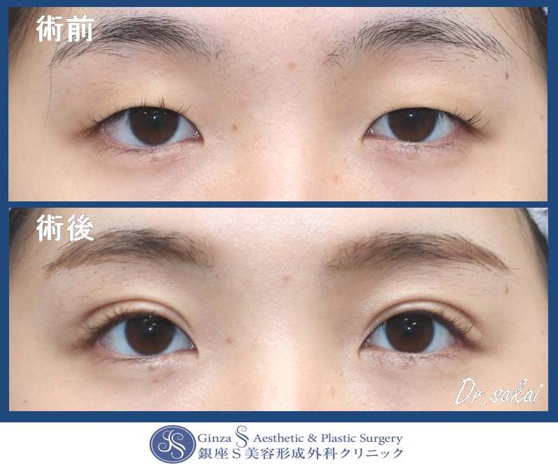 眼の形成 35 目力アップ 切らない眼瞼下垂 埋没法による重瞼術の経過のご紹介 銀座s美容 形成外科クリニック 眼の形成 35 目力アップ 切らない眼瞼下垂 埋没法による重瞼術の経過のご紹介 銀座s美容 形成外科クリニック