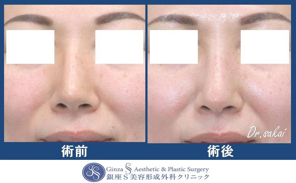 鼻の形成 30 他院修正 l型プロテーゼ抜去 I 型 プロテーゼに入れ替え 鼻先耳介軟骨移植 銀座s美容 形成外科クリニック 鼻の形成 30 他院修正 l型プロテーゼ抜去 I 型 プロテーゼに入れ替え 鼻先耳介軟骨移植 銀座s美容 形成外科クリニック