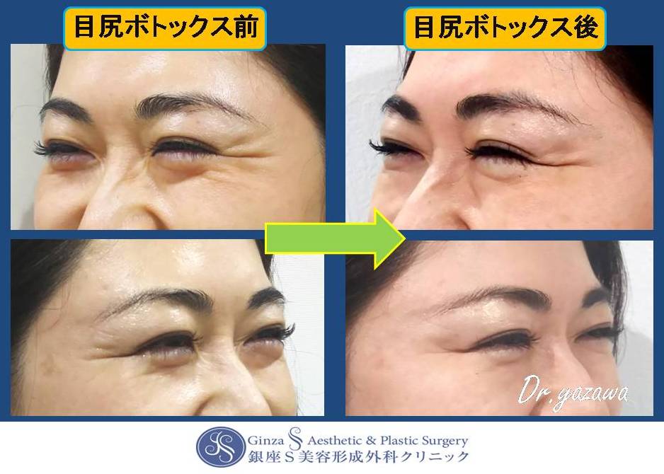 しわ治療 ボトックス注射 銀座s美容 形成外科クリニック