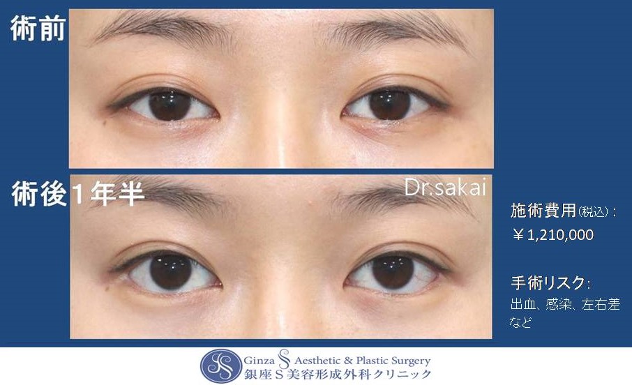 たれ目形成 目尻切開 目力アップ 銀座s美容 形成外科クリニック たれ目形成 目尻切開 目力アップ 銀座s美容 形成外科クリニック