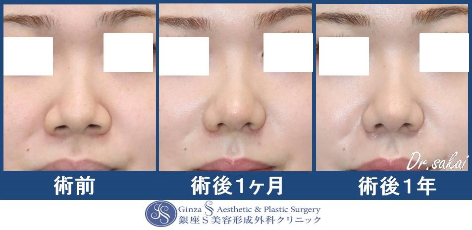 鼻翼縮小術(皮弁法) | 銀座S美容・形成外科クリニック