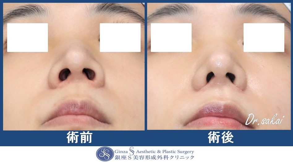鼻翼縮小術(皮弁法) | 銀座S美容・形成外科クリニック
