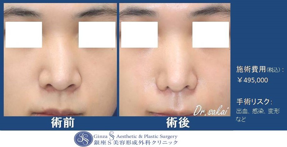 鼻翼縮小術(皮弁法) | 銀座S美容・形成外科クリニック